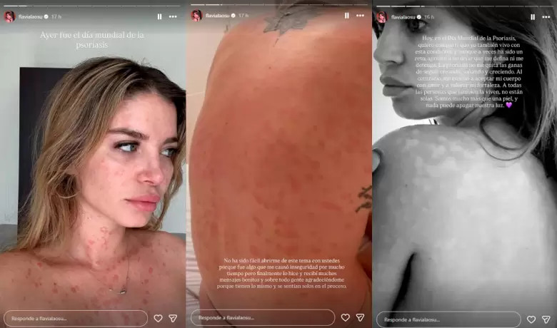 Flavia Laos se pronuncia por el Día Mundial de la Psoriasis. (Instagram)