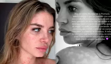 Flavia Laos habla con el corazón sobre su psoriasis.