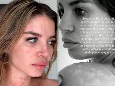 Flavia Laos habla con el corazón sobre su psoriasis.