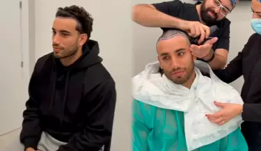Said Palao se muestra rapado y cuenta sin miedo su trasplante capilar.