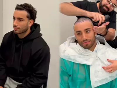 Said Palao se muestra rapado y cuenta sin miedo su trasplante capilar.